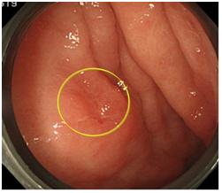 写真：通常観察における早期胃がん（5mm）