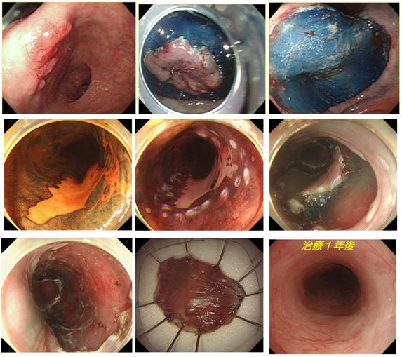 写真：早期胃がんに対する内視鏡的粘膜下層剥離術（ESD）